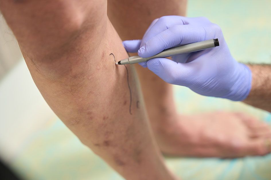 Tratamiento varices medicina estética